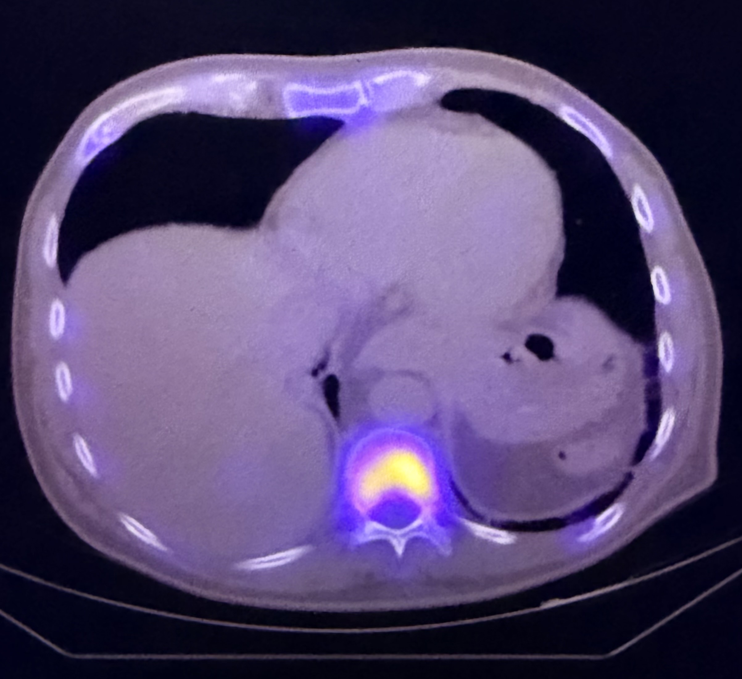 PET/CT example used to illustrate advanced thyroid cancer staging