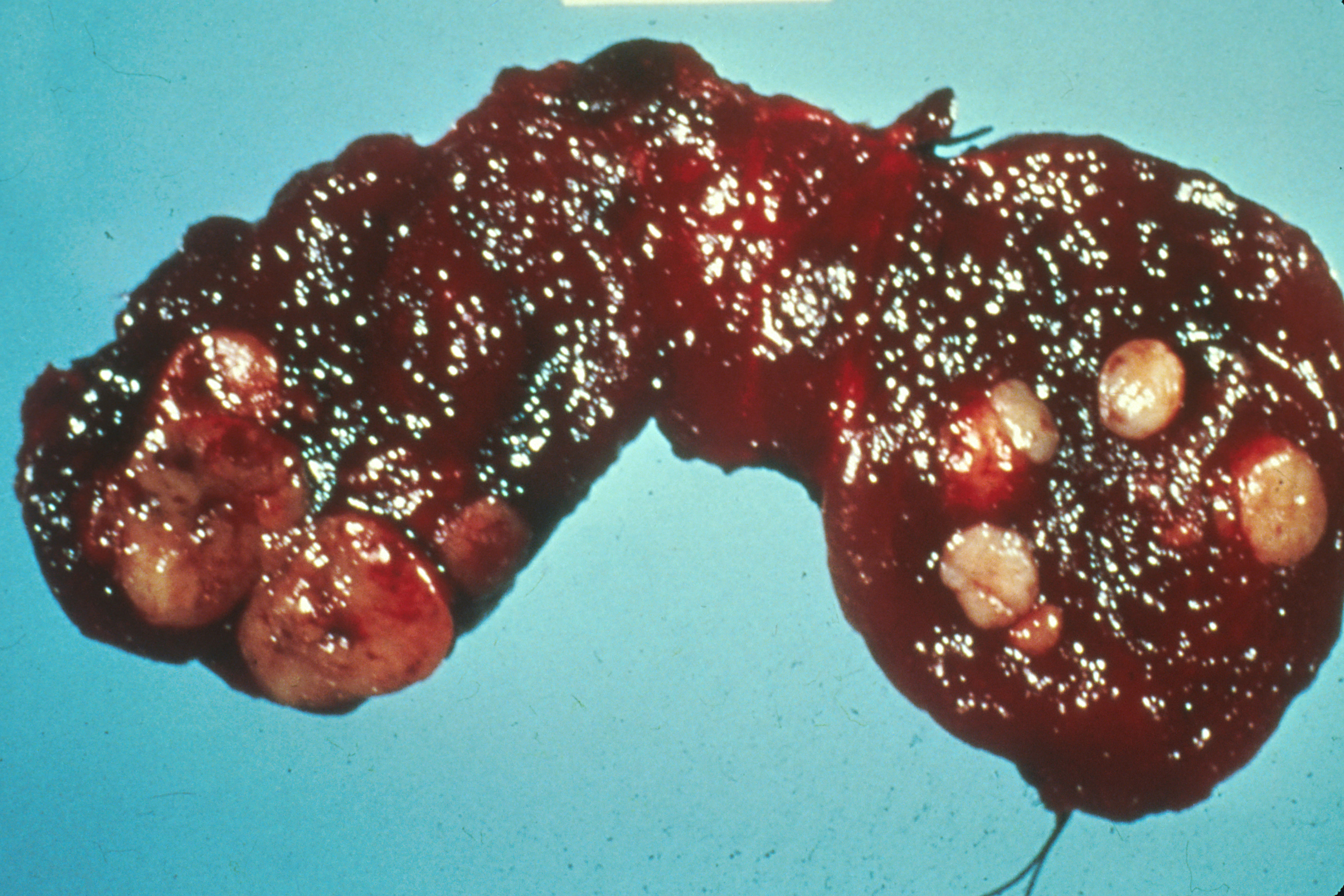 Gross pathology specimen of human thyroid cancer