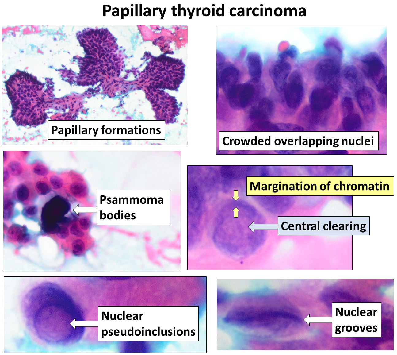 Cytopathology of papillary thyroid carcinoma