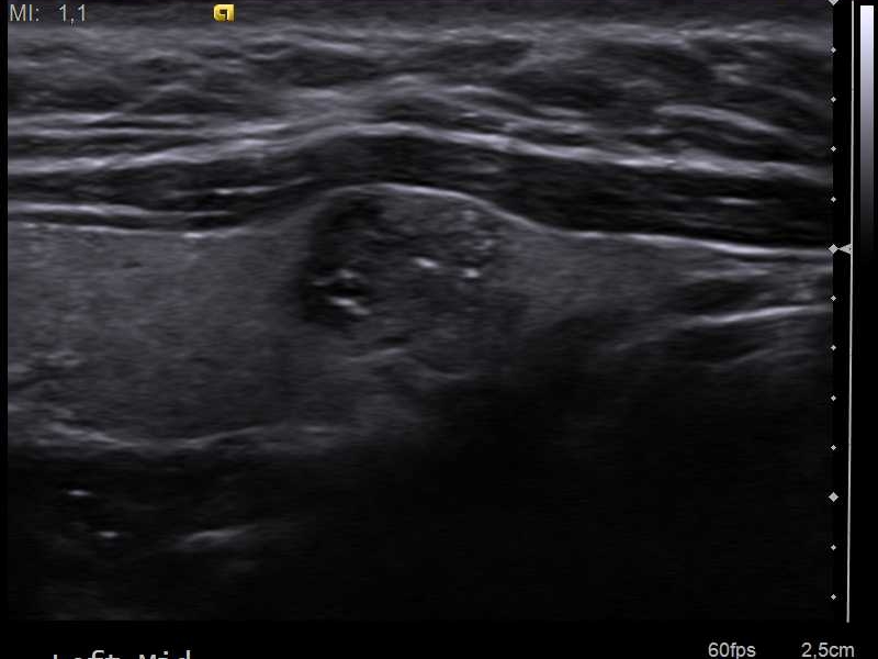 Ultrasound image of papillary thyroid carcinoma